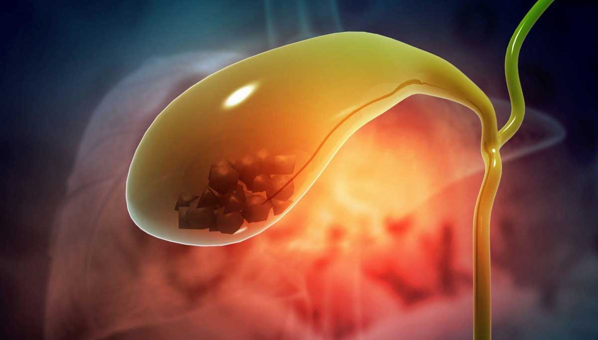 Safra Taşı Nedir Kimlerde Ve Nasıl Oluşur?